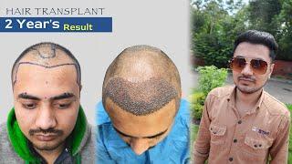 Hair Transplant in Ujjain | Cost of Hair Transplant in Ujjain | Hair Transplant Doctor in Ujjain