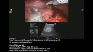 BK Medical  Robotic assisted Partial Nephrectomy with 3D Rendering by Michael Stifelman, MD