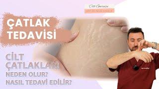 Çatlak Tedavisi. Cilt çatlakları neden olur? Nasıl tedavi edilir?