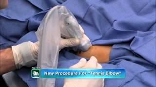 The Doctor’s Show feature:  New procedure to relieve tennis elbow