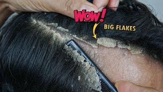 Itchy Dry Scalp Big Dandruff Scratching #1185