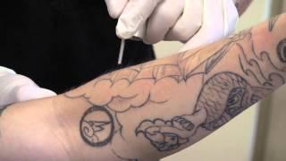 Laser Tattoo Removal Demonstration by Dr. P. Alexander Ataii, M.D.