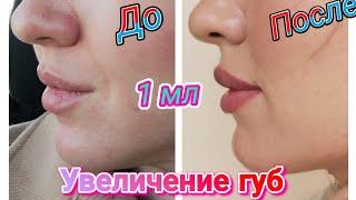 Увеличение губ 1 мл до / после. Натуральный эффект.TEOSYAL 1мл