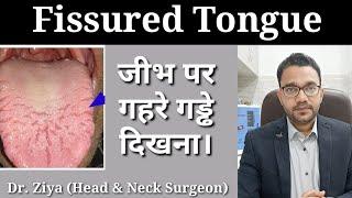 Fissured Tongue. Tongue Fissure. Oral Ulcer. Tongue Ulcer. जीभ पे छाले।