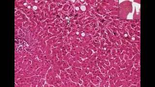 Histopathology Liver--Cholestasis