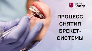 Процесс снятия брекет-системы