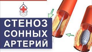  Уникальный метод лечения атеросклероза сонных артерий. Лечение атеросклероза сонных артерий. 12+