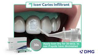 Icon Smooth Surface Caries Infiltrant, Quick Guide