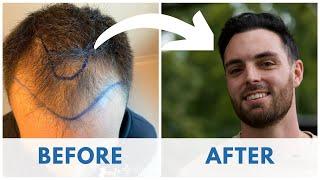 Hair Transplant Before and After - Month by Month results Elithair