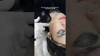 Cicatriz de acne tem tratamento?