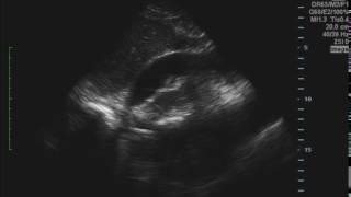 Cardiac Tamponade, Ultrasound. JETem 2016.