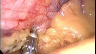 Laparoscopic fundoplication by Wael Tobar MD