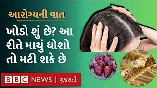 Dandruff થી મુક્તિ મેળવવા અપનાવો માથું ધોવાની આ રીત Health Explainer