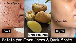 Potato Face Pack for Skin Whitening, DARK SPOTS, Open Pores, Hyperpigmentation - Chicken Pox scars