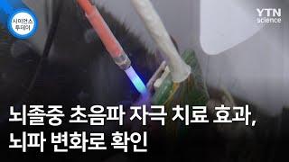 뇌졸중 초음파 자극 치료 효과, 뇌파 변화로 확인 / YTN 사이언스