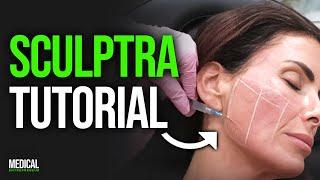 How to Inject Sculptra for Facial Volume Loss & Glowy Skin | Full Procedure Demonstration