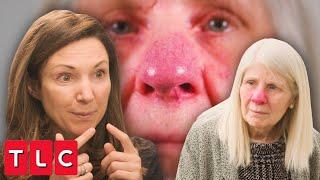 Dr. Emma Treats Trish's Severe Rosacea | Save My Skin