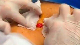 World's Largest Pimple?  Back Cyst, Dr. John Gilmore
