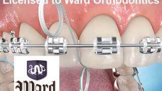 Flossing with superfloss - Ward Orthodontics - Fort Collins, Colorado