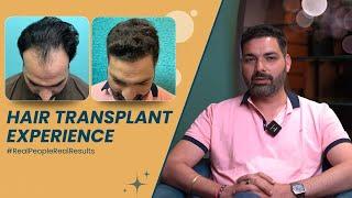 Amazing Results after 9 months | Real People Real Results | Hair Transplant in Delhi | SkinQure