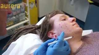 Stretched Earlobe Repair (54mm), Part 1 - Aurora Clinics