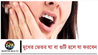 মুখের ভেতর ঘা বা গুটি হলে যা করবেন || Mouth Infection || Health Tips || DeeptoTV