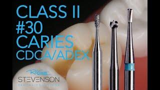 Class II Amalgam Preparation #30 MO CARIES!  | Dr. Richard Stevenson