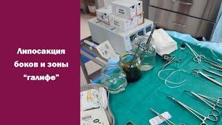 Липосакция боков и зоны "галифе". Пластический хирург Константинова И.В.