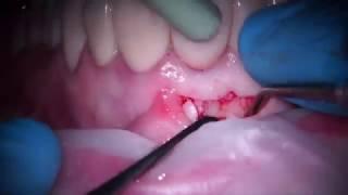 Endodontic micro surgery