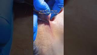 Thread Lift Procedure at The Aesthetic Edge @TheAestheticEdge_