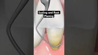 Scaling and root planing (3D Animation)