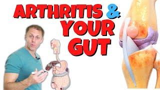 The Gut and Arthritis Connection