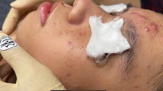 Blackheads Removal On Boy Face 2024[FULL] | Acne Treatment Bo Nguyễn Spa