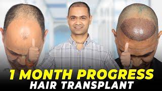 Hair Transplant in Sikar | Best Results & Cost of Hair Transplant in Sikar