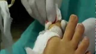 Ingrown Toe Nail