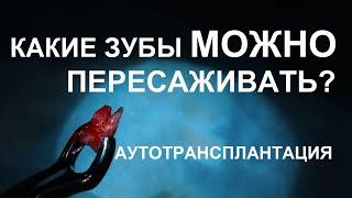 Какой зуб можно пересадить при аутотрансплантации? - Немецкий имплантологический центр, Москва