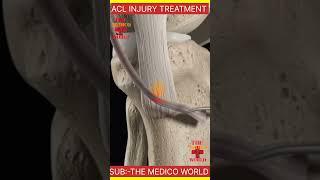 Arthroscopic procedure of ACL ligament injury|| 3D Animated Surgery|| The Medico World||#Surgery||