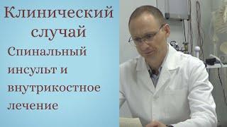 Внутрикостное лечение в терапии последствий спинального инсульта, клинический случай