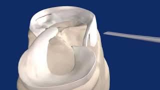 Fast Fix  Meniscal Repair