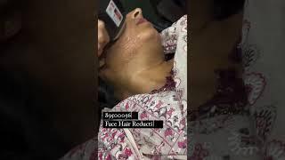 LASER HAIR REMOVAL |Permanent hair removal |Laser | Hair Removal #viral #shorts #hair #skincare