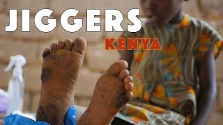 Jiggers and Our Kids in Africa.  Черви в ногах и Наши Дети в Африке.