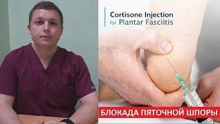 Блокада пяточной шпоры | Plantar Fasciitis Injection Treatment