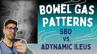 SBO vs. Adynamic Ileus! Learn the 3-6-9 rule to read bowel gas patterns on X-rays!