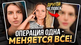 ВЕРХНЯЯ БЛЕФАРОПЛАСТИКА - СМОТРИТЕ ПЕРЕД ТЕМ, КАК ДЕЛАТЬ!