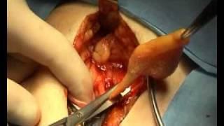 Repair of Inguinal Hernia (Lichtenstein)