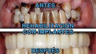 CIRUGÍA ORAL - IMPLANTES DENTALES - VIDEO RESUMEN - FORMACIÓN EN IMPLANTOLOGÍA - DR. ISMAEL SORIANO