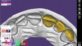 EXOCAD Modelling #2 Моделируй правильно виниры. Dental cadcam