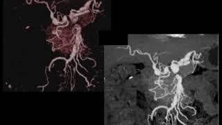 MDCT/CTA Evaluation of the Liver: Beyond Tumors Part 3