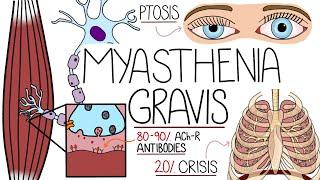 Myasthenia Gravis Explained Clearly