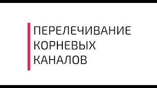 Перелечивание корневых каналов зуба показания и противопоказания